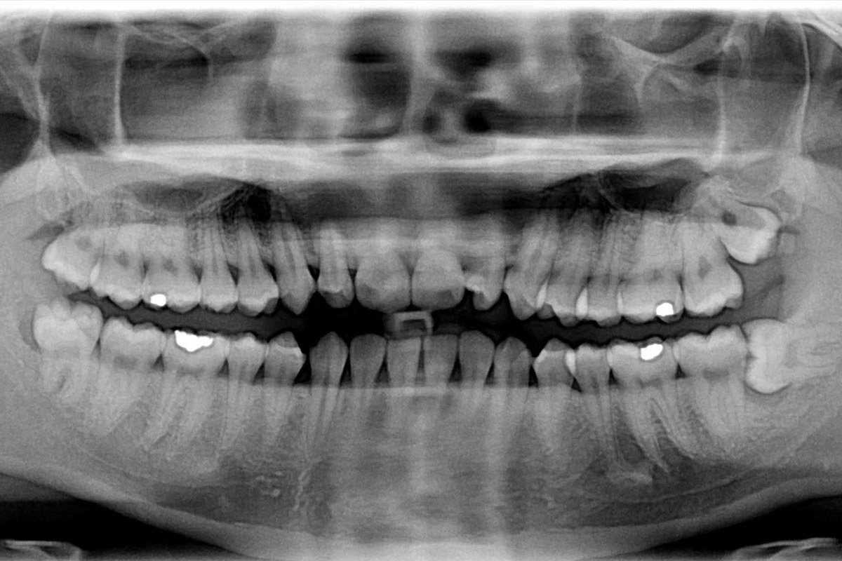 Curiosidades Fascinantes Sobre Os Dentes Do Siso Mega Curioso