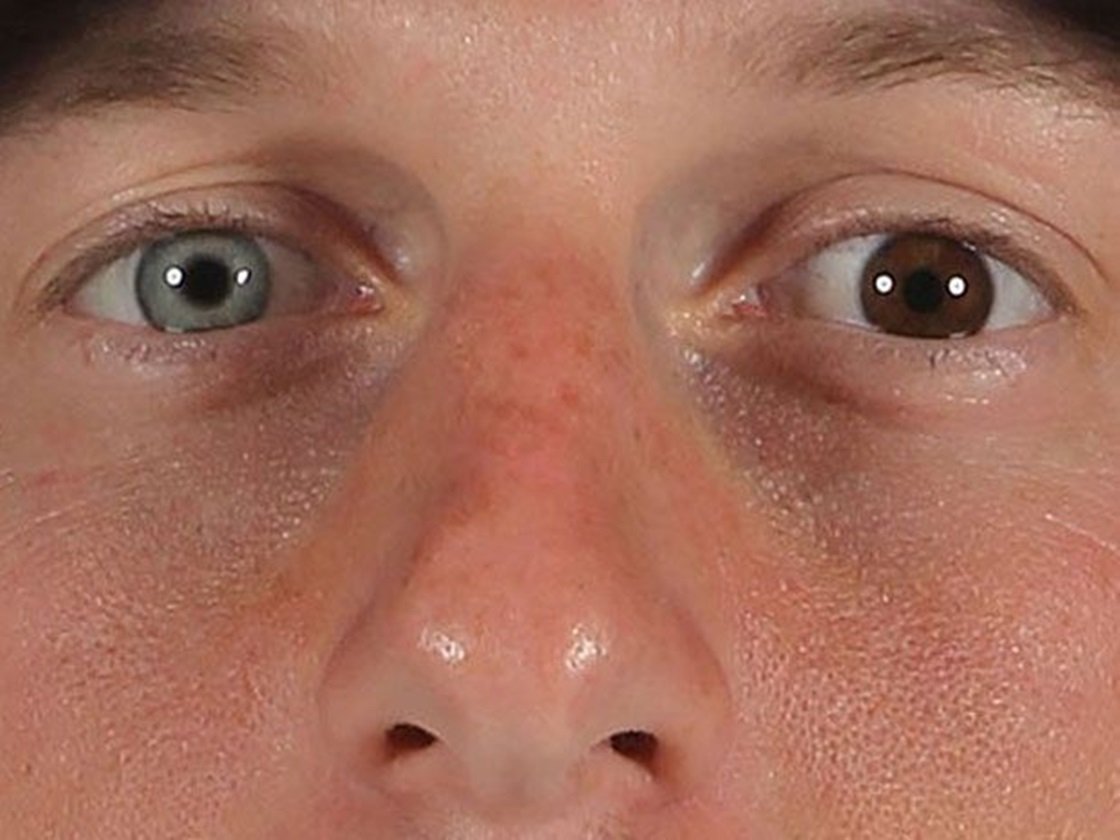 Ocular sob tratamento veia azul