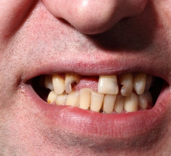 Descubra o que causa o amarelamento dos dentes