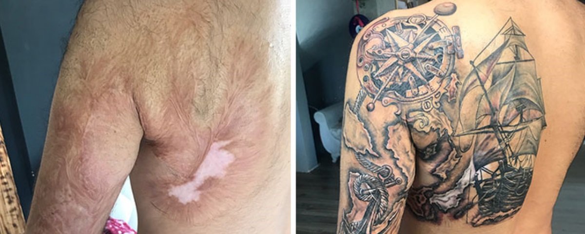 Mais 15 sinais e cicatrizes transformadas em arte pelas tatuagens