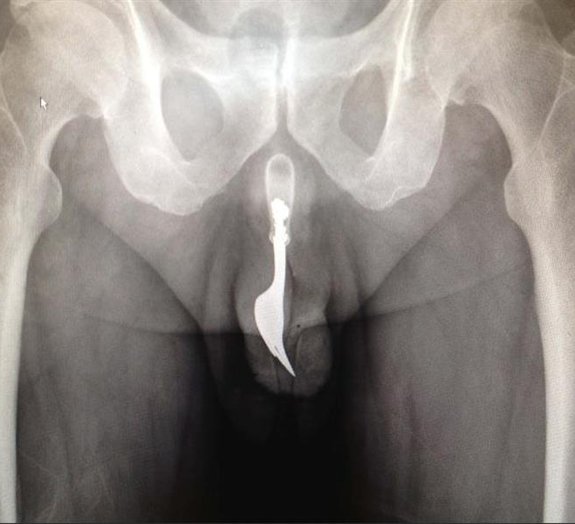 Garfo de 10 centímetros é retirado da uretra de septuagenário