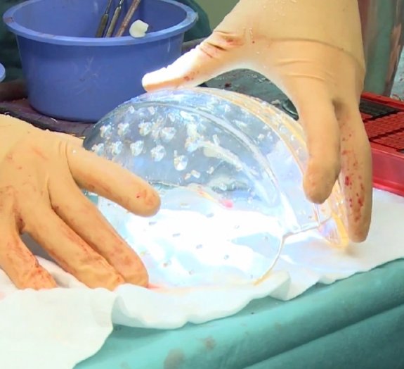 Imagens fortes: mulher recebe prótese de crânio feita em impressora 3D