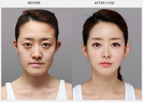 Jovem de Novo Hamburgo faz dez cirurgias para ter olhos de coreanos