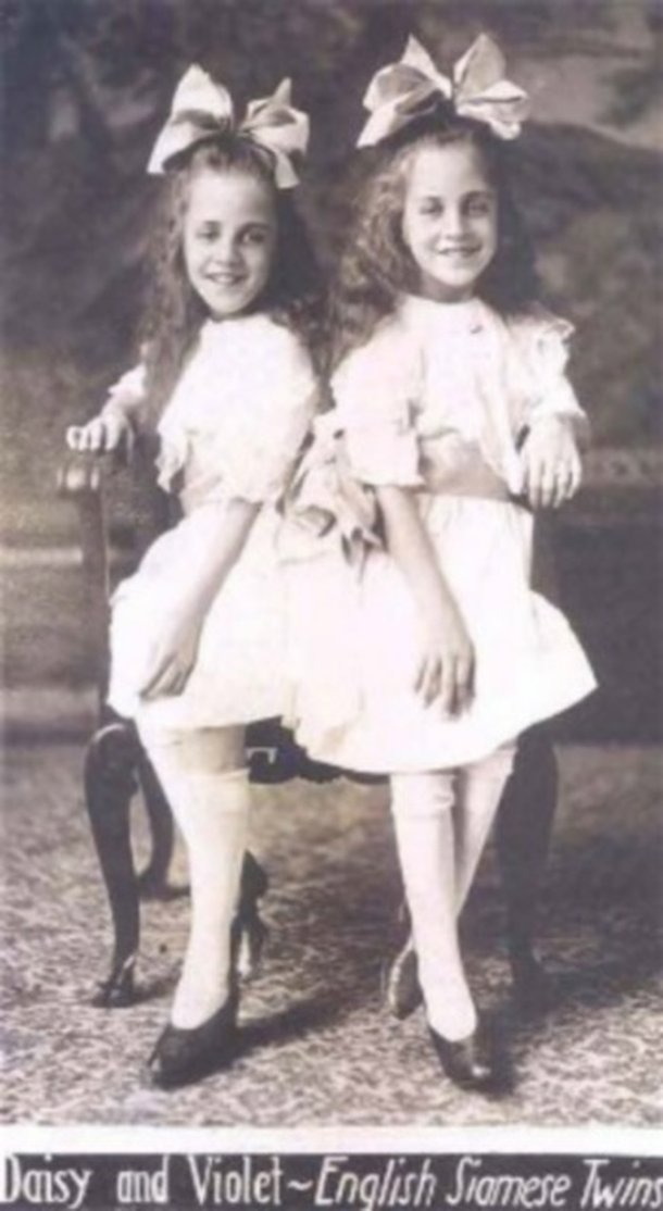 Gêmeas siamesas em foto em preto e branco.