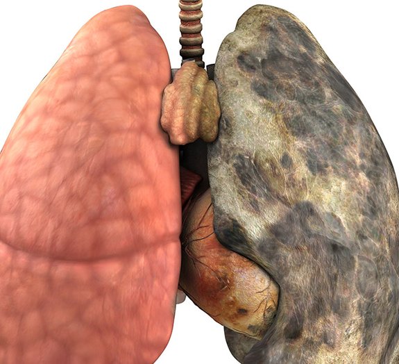 Veja a diferença entre um pulmão de um fumante e um pulmão sadio [vídeo]
