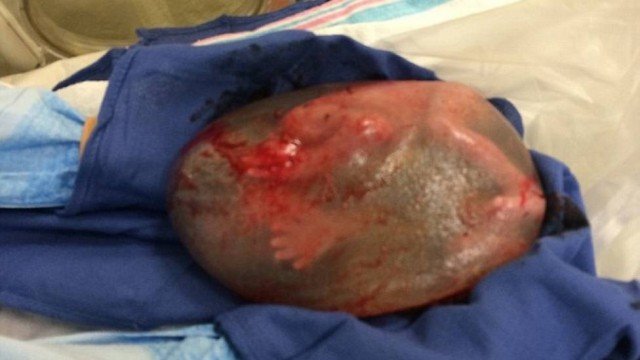 Pequeno milagre: bebê prematuro nasce dentro de saco amniótico nos EUA