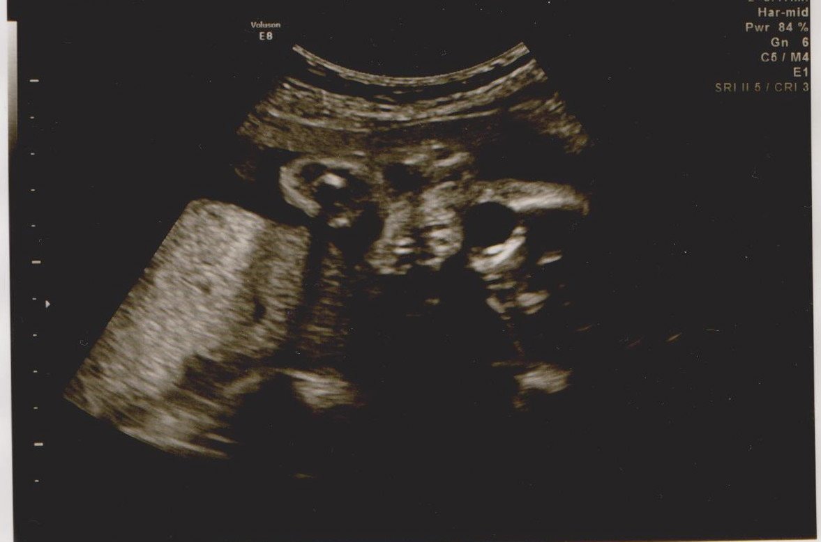De dar medo: estes ultrassons farão você pensar 2 vezes antes de ter filhos