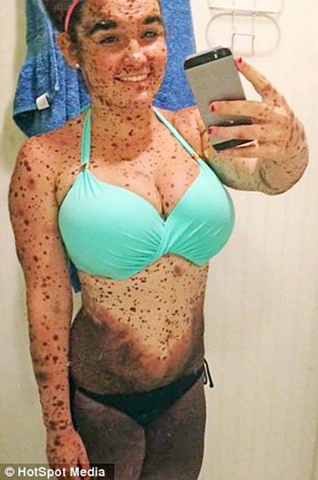 A história da jovem que nasceu com 70% do corpo coberto por manchas