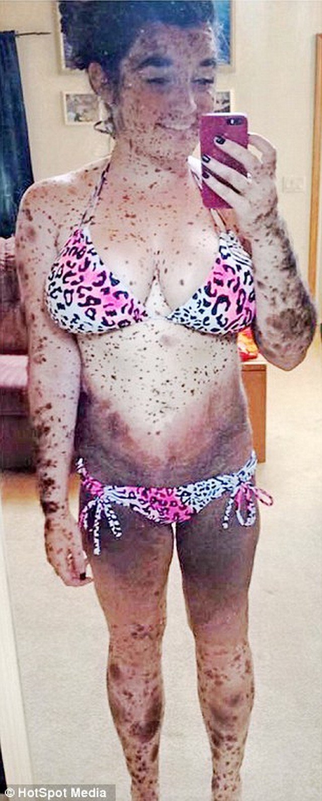 A história da jovem que nasceu com 70% do corpo coberto por manchas