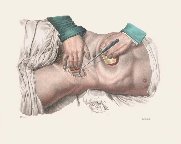 Impressionante! Veja ilustrações de cirurgias feitas no século 19