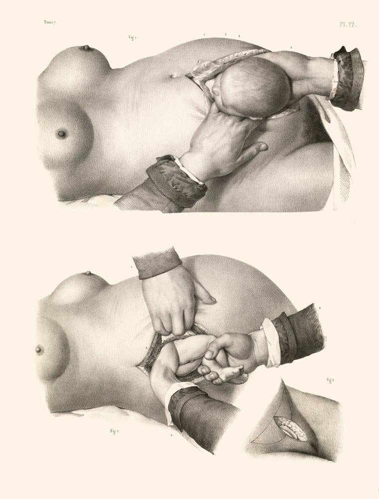 Impressionante! Veja ilustrações de cirurgias feitas no século 19