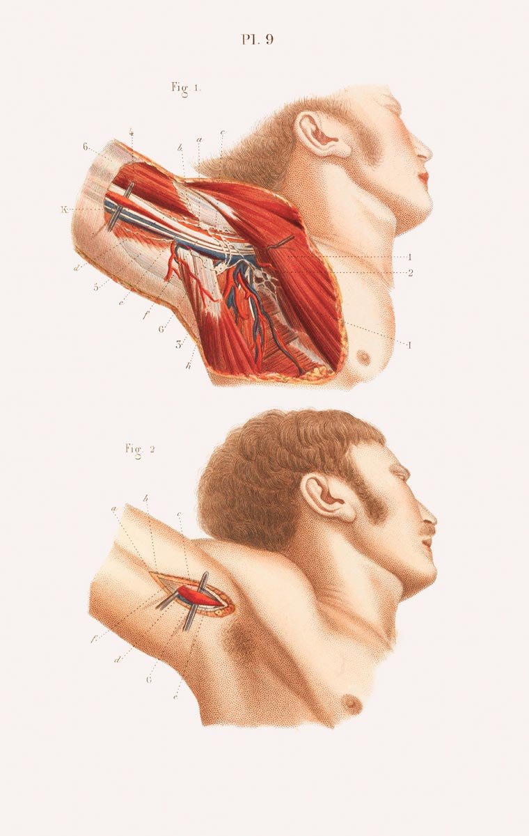 Impressionante! Veja ilustrações de cirurgias feitas no século 19