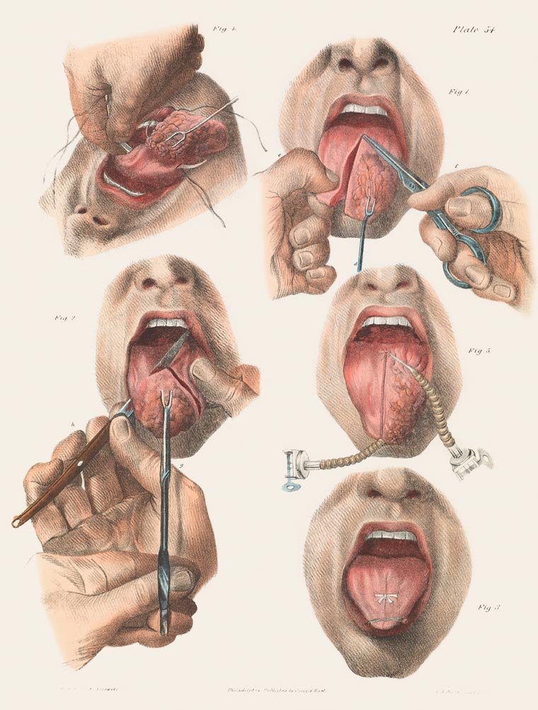 Cirurgia para retirada de câncer na língua