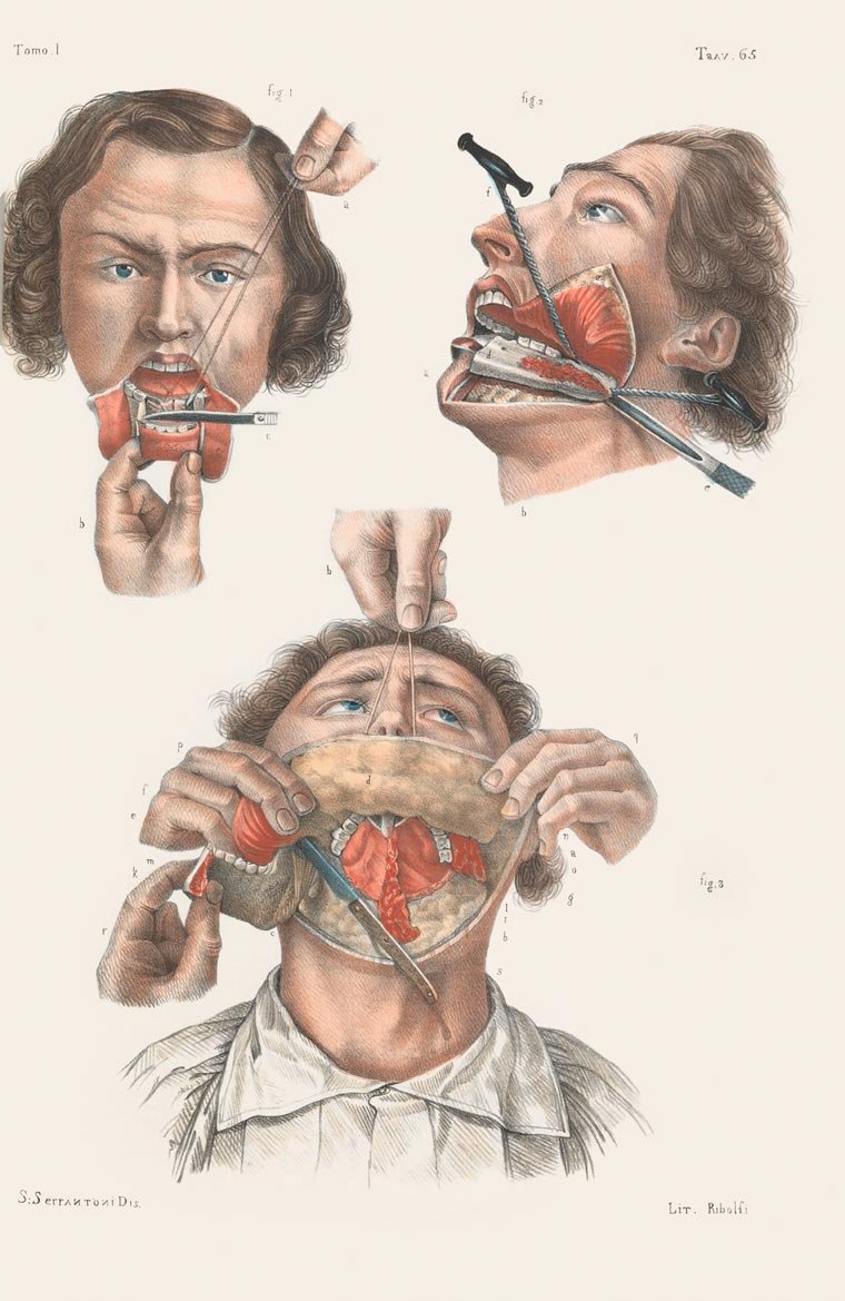 Impressionante! Veja ilustrações de cirurgias feitas no século 19