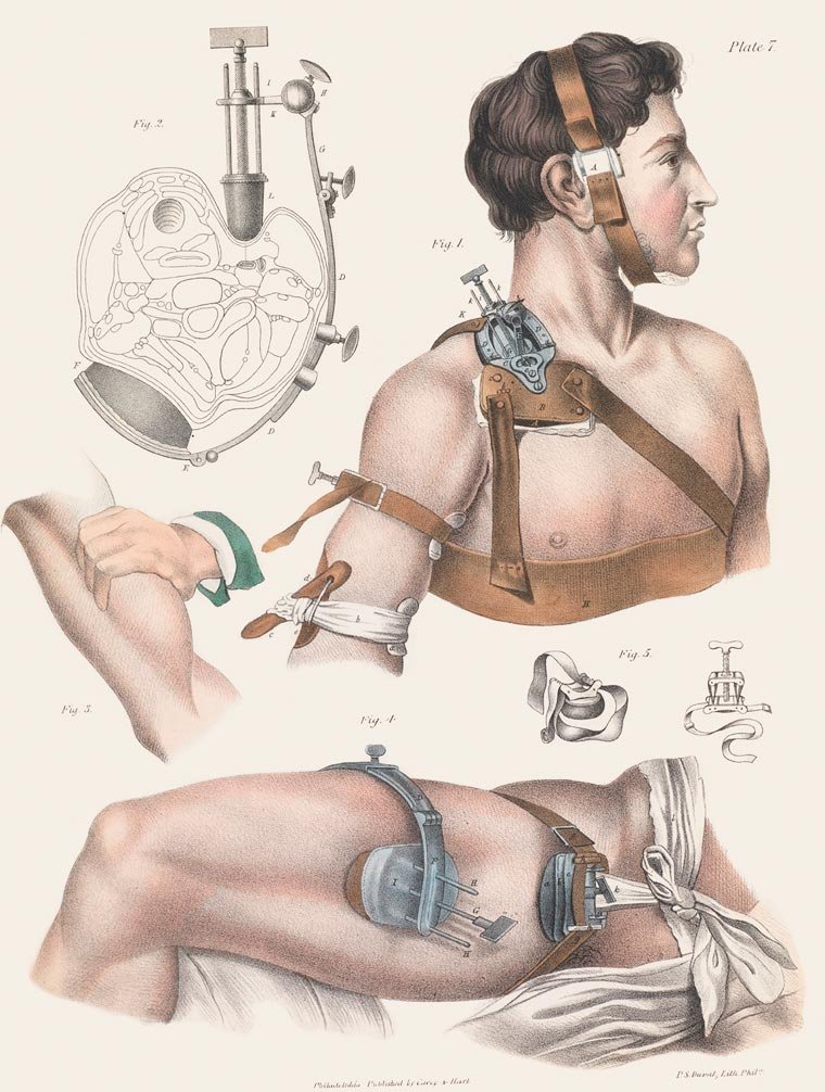 Impressionante! Veja ilustrações de cirurgias feitas no século 19