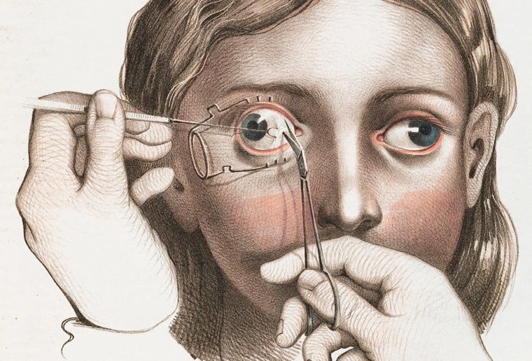 Cirurgia para tratamento do estrabismo
