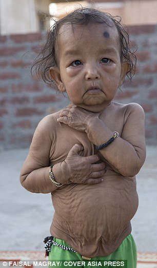 Irmãos indianos sofrem de condição rara que os faz parecerem velhinhos