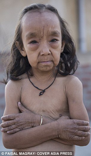 Irmãos indianos sofrem de condição rara que os faz parecerem velhinhos