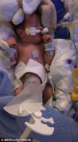 Milagre da medicina: bebê sobrevive mesmo nascendo com intestino para fora