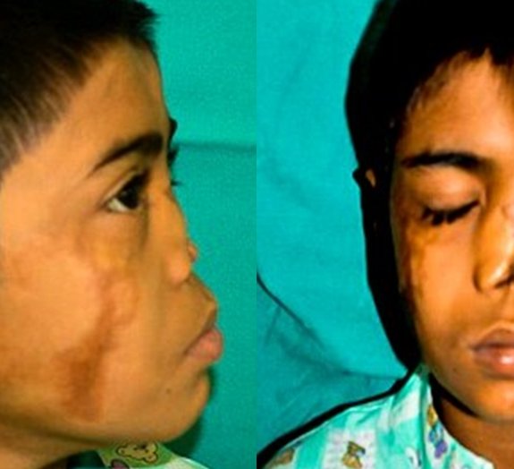 Depois de perder órgão, garoto tem um nariz crescendo em sua testa