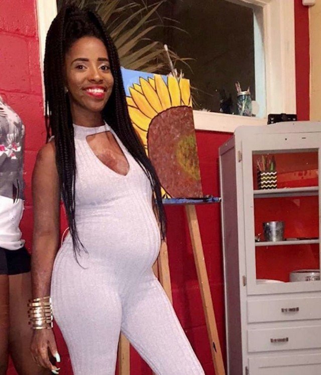 Mulher sobrevivente de incêndio exibe cicatrizes em fotos de sua gestação