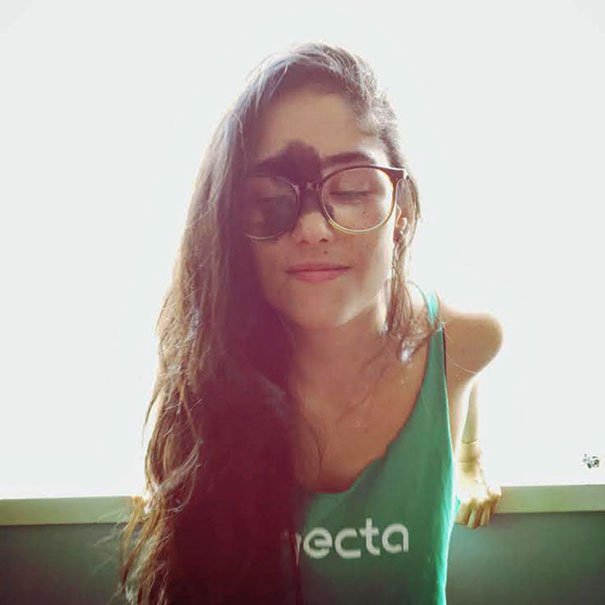 A brasileira que ficou mundialmente famosa por causa de marca de nascença