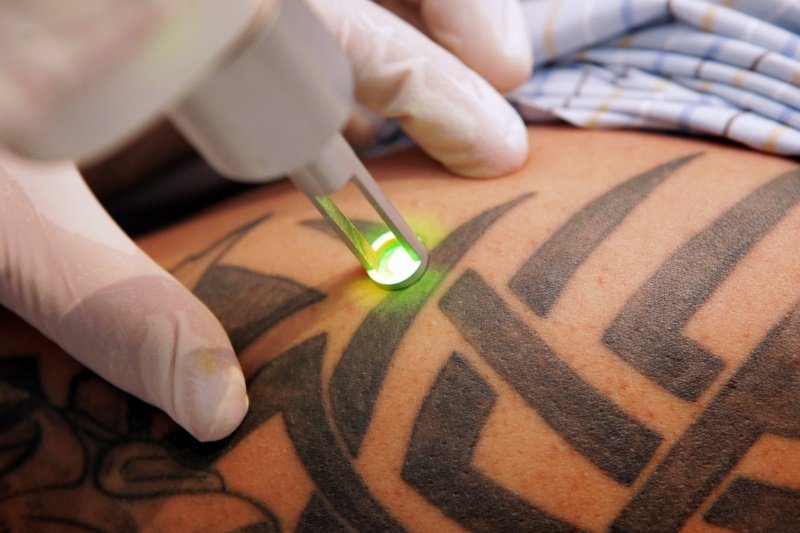 laser remoção tatuagem braço