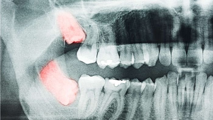 Dentes do siso