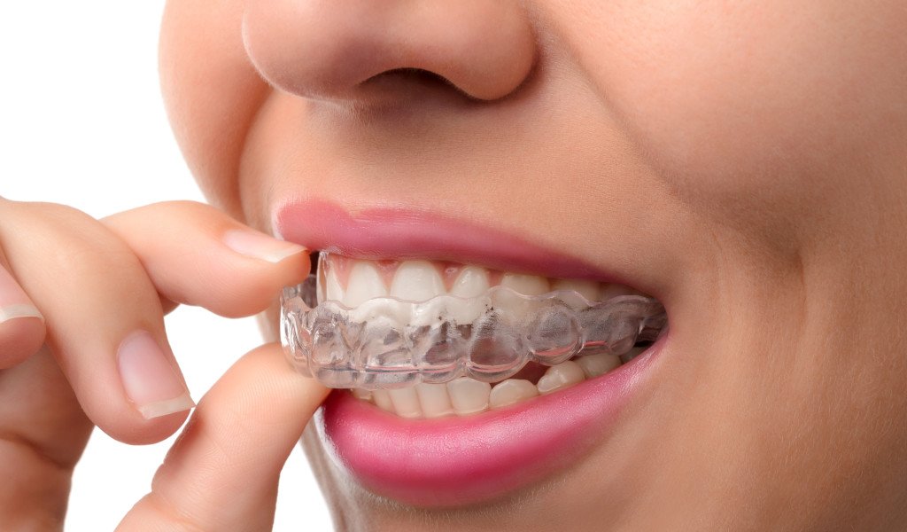 Bruxismo 5 Indícios que você tem e não sabe - Amo Odontologia
