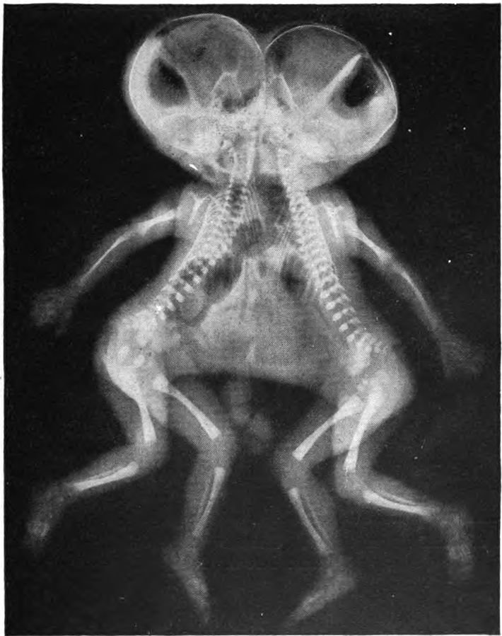 Radiografia gêmeos siameses 