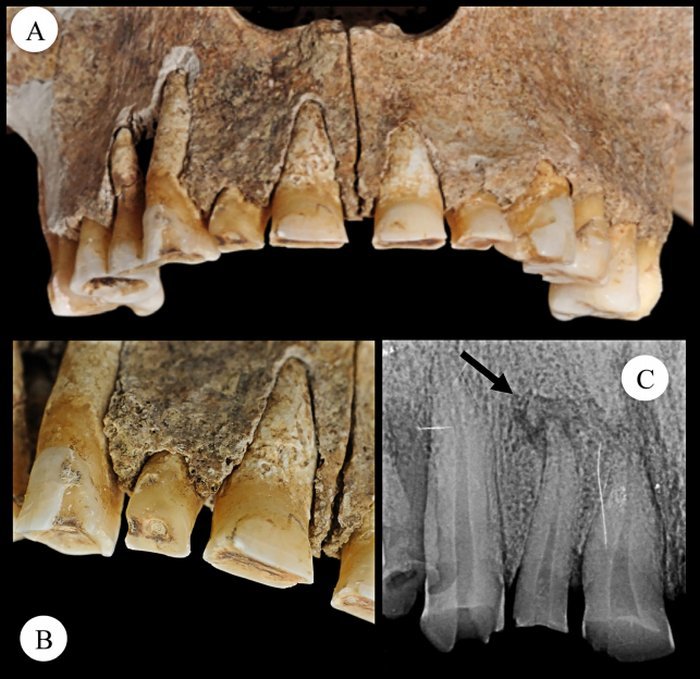 Dentes mostrando desgaste