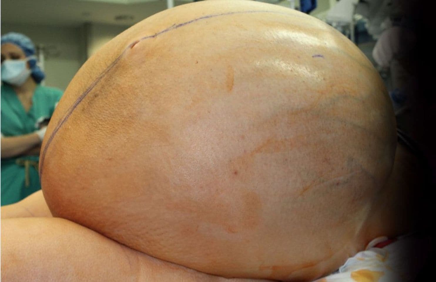 Tumor colossal de ovário
