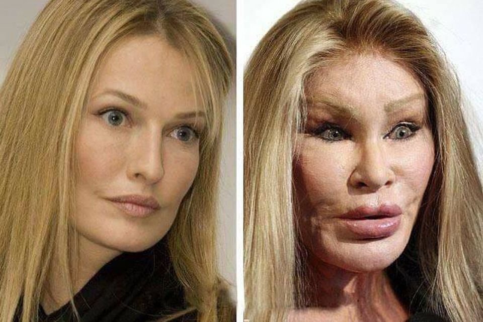 Donatella Versace antes e depois da cirurgia: foto 