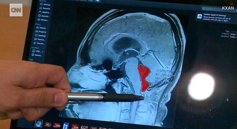 Ressonância magnética que identificou a tênia no cérebro de Gerardo Moctezuma