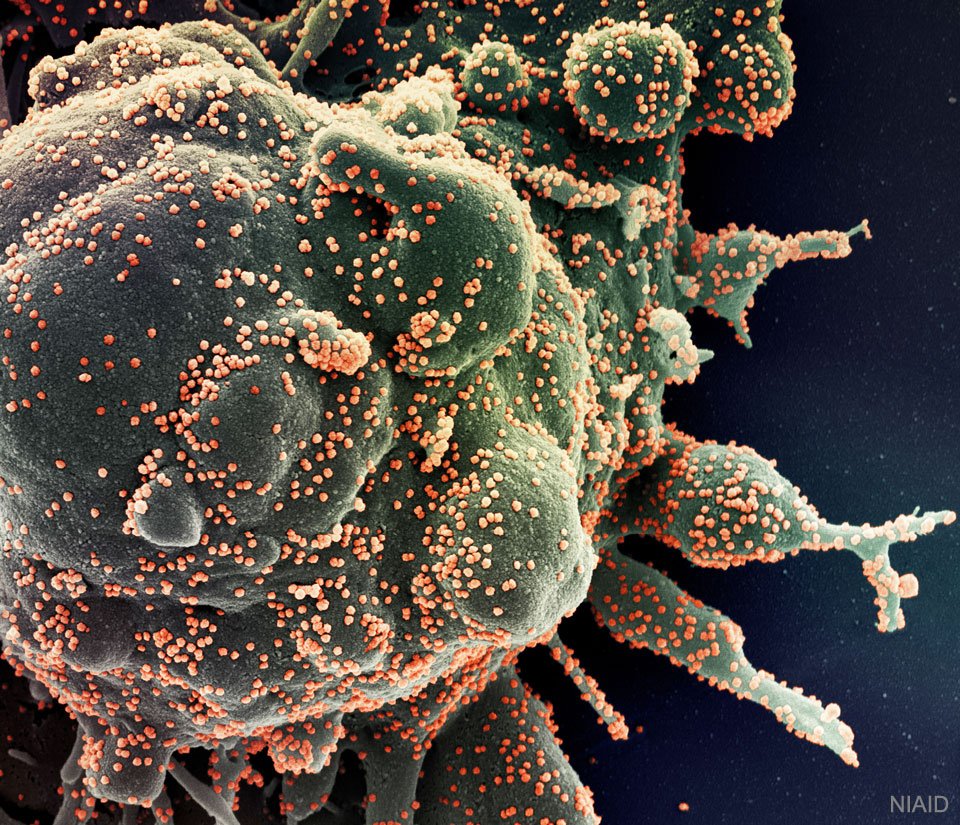 O vírus SARS-CoV-2 (representado por pontinhos laranjas) está na superfície da célula (estrutura maior)