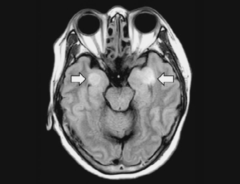 Imagem do cérebro de uma mulher infectada que desenvolveu encefalite, com danos aos tecidos do cérebro (setas).