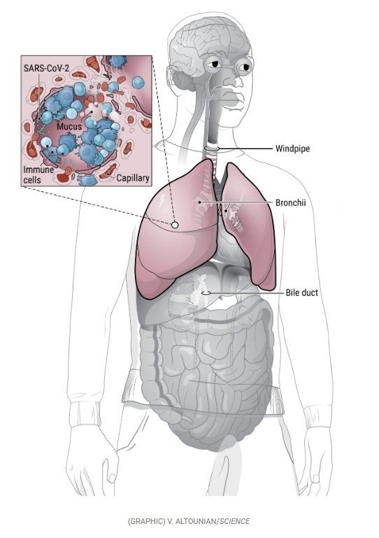 Células imunes se aglomeram em um alvéolo inflamado, cujas paredes se rompem durante o ataque do vírus, diminuindo a captação de oxigênio dos pulmões.