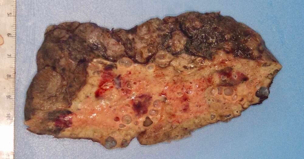 O pulmão removido de dentro da paciente que sobreviveu ao coronavírus. (Fonte: Northwestern Medicine/Divulgação)