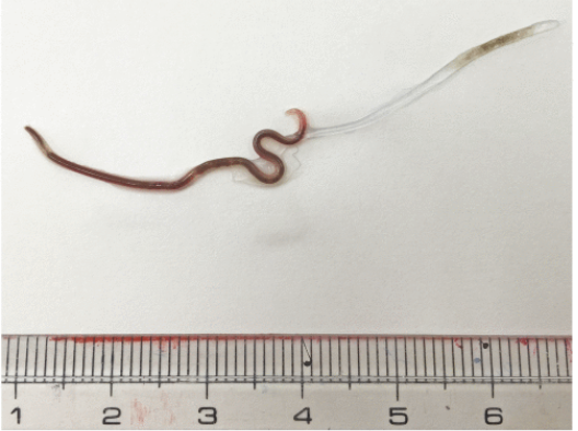 O verme que foi retirado da japonesa. (Fonte: Official Journal of the American Society of Tropical Medicine and Hygiene/Twitter/Reprodução)