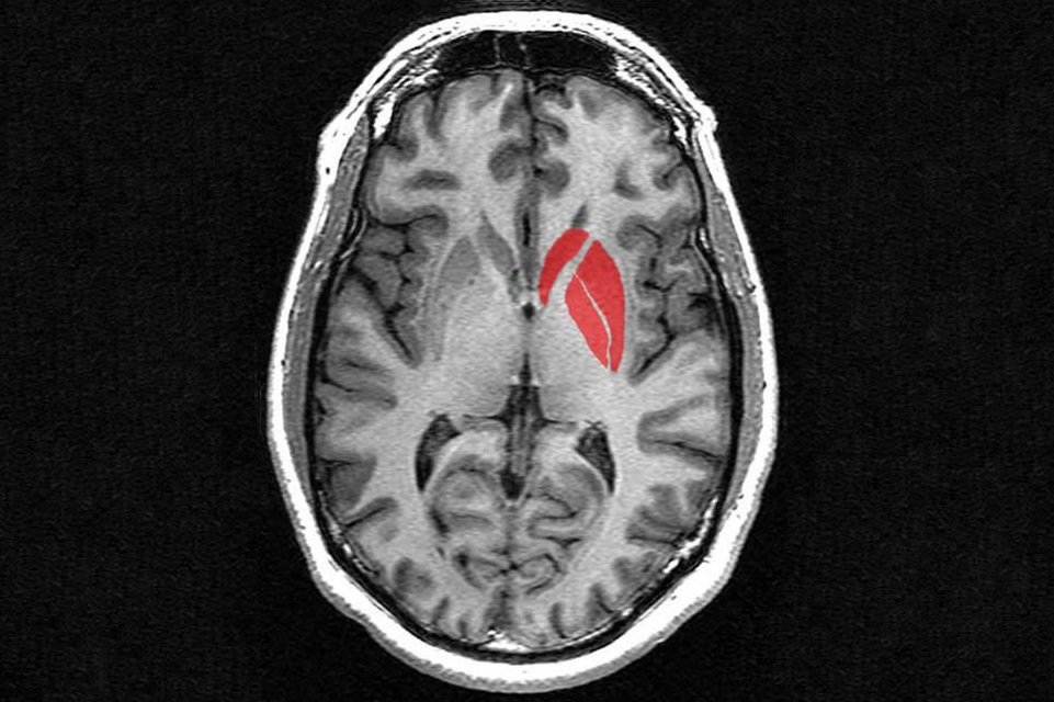 A mancha em vermelho indica o corpo estriado, responsável pelos sistemas motor e de recompensas do cérebro.