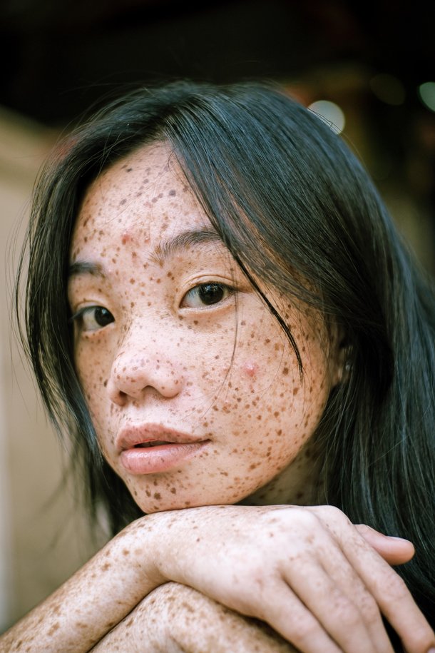 Sardas são exemplos de tumores benignos na pele. (Fonte: Pexels)