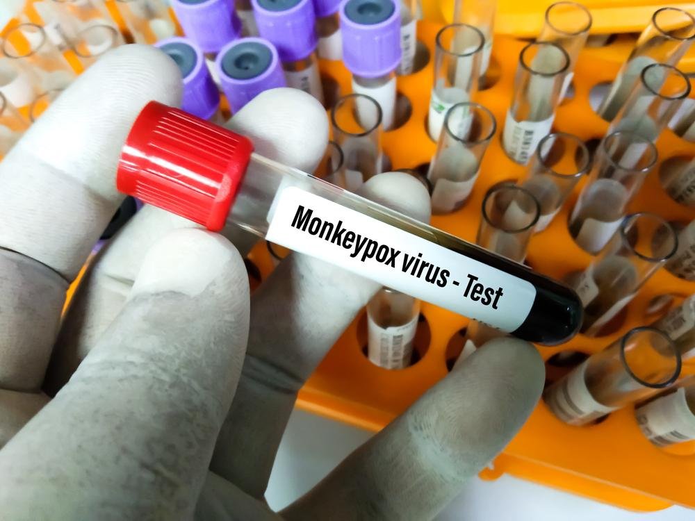 Teste do vírus da varíola do macaco. (Fonte: Shutterstock)
