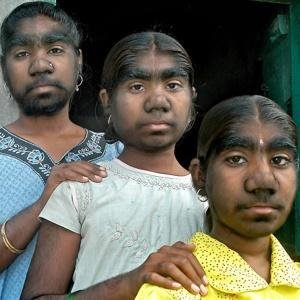 As irmãs Raut da Índia sofrem de uma doença extremamente rara conhecida como “síndrome do lobisomem”.