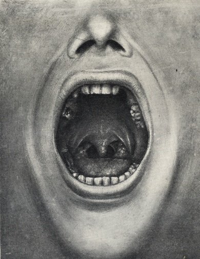 Ilustração de uma boca com dentes faltando, retirados de um livro de Henry Cotton, de 1921. (Fonte: Princeton University Press/Wikimedia Commons)