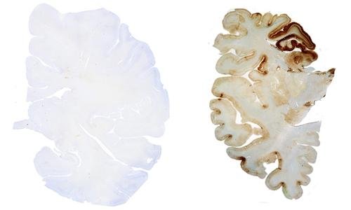 Imagem compara cérebro saudável (esquerda) com um afetado pela ETC (direita), doença que lentamente mata células cerebrais. (Fonte: Dr. Ann Mckee/Boston University/Reprodução)