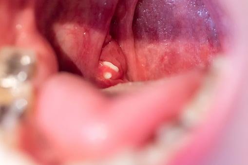 Bolinhas brancas na garganta: por que causam mau hálito?