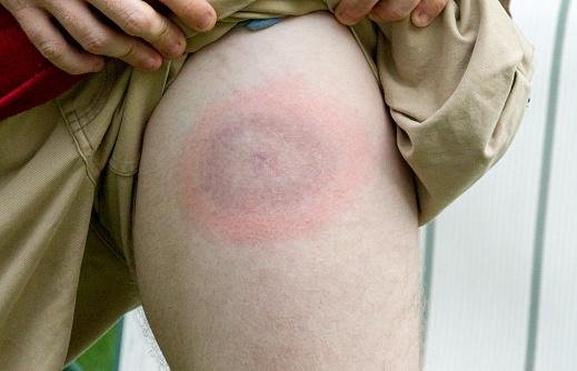 Um dos primeiros sinais da infecção por Lyme são os característicos anéis avermelhados na pele (Fonte: Getty Images/Reprodução)