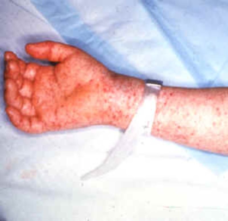 Perigosa, a febre maculosa pode levar à amputação de membros e até a sépsis (Fonte: Wikimedia Commons/Reprodução)