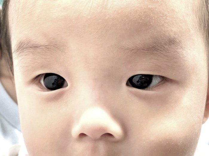 Olhos do bebê em sua versão normal. (Fonte: Frontiers in Pediatrics/Divulgação)