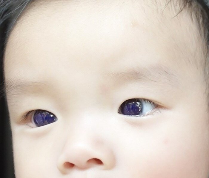 Cor azulada após o tratamento. (Fonte: Frontiers in Pediatrics/Divulgação)